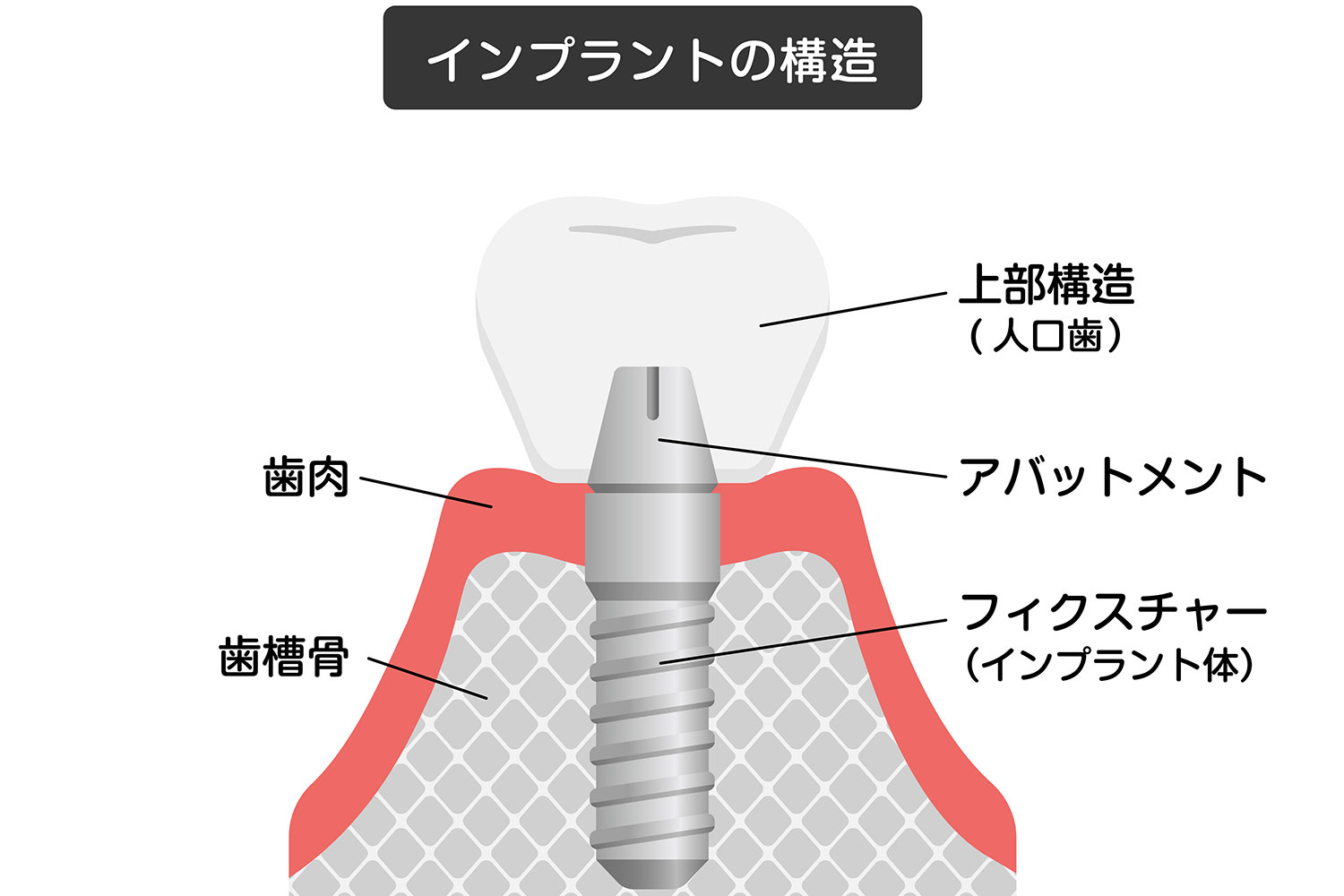 インプラントの構造