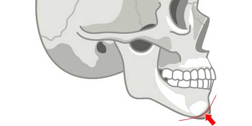 オトガイ形成手術