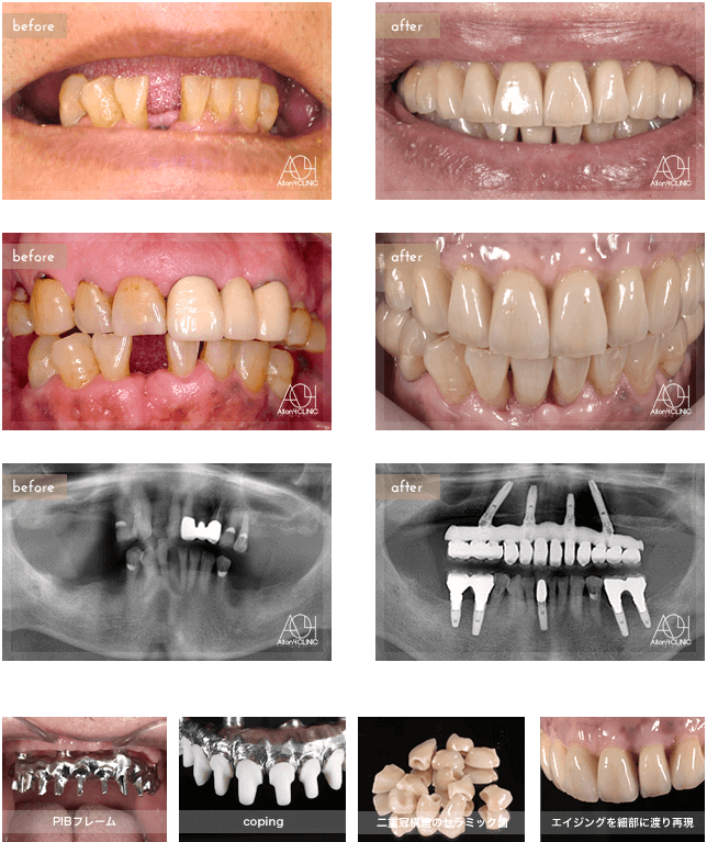 上顎All-on-4。上顎上部構造は二重冠構造（歯肉：アクリリックレジン／歯：セラミック）を採用。上顎の上部構造は、下顎に合わせエイジングを細部に渡り再現。