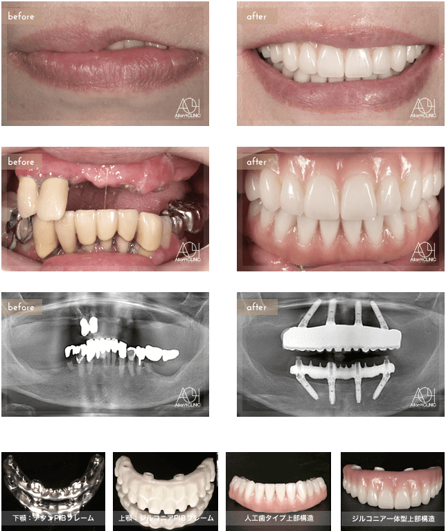 重度歯周病により、全顎的All-on-4による治療。上顎上部構造はジルコニア一体型（歯肉：セラミック／歯：セラミック／ジルコニアPIBフレームに歯肉・歯ともにセラミックを築成）を採用。下顎は人工歯タイプを採用。上顎はジルコニアPIBフレーム。下顎はチタンPIBフレーム。