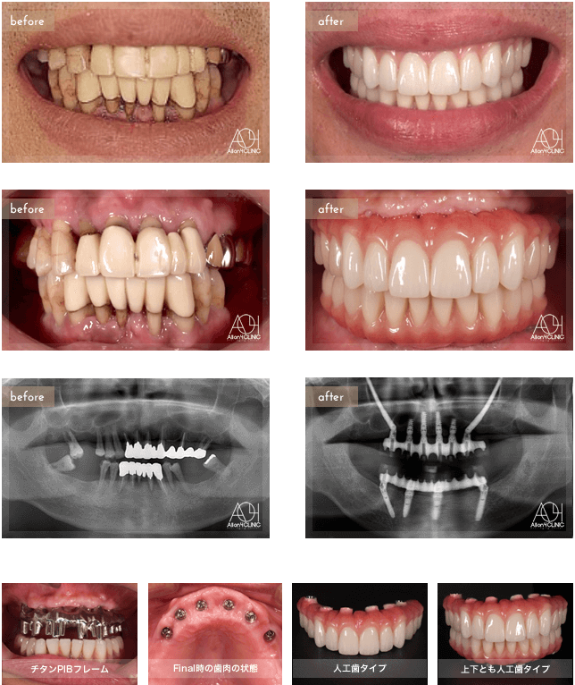 40代男性の上顎ザイゴマハイブリッド下顎オールオンフォー症例 オールオン4なら東京で数多くの症例 オールオンフォークリニック銀座