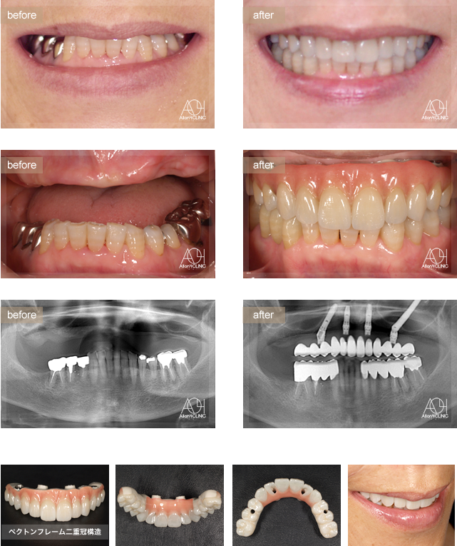 治療例 オールオン4なら東京で数多くの症例 オールオンフォークリニック銀座