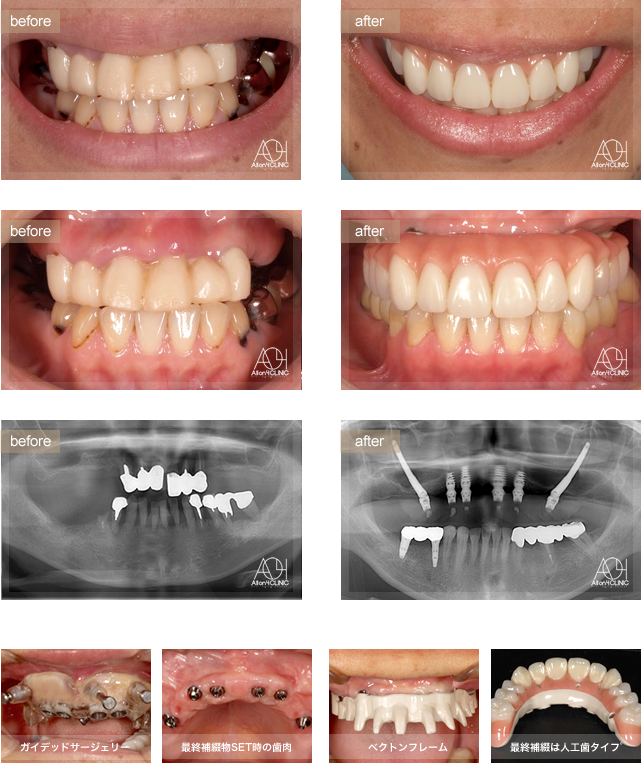上顎両側Zygoma、前方４本のNobel Activeインプラントを使用。 上顎上部構造はペクトンフレーム（歯肉：アクリリックレジン　歯：人工歯）を採用。