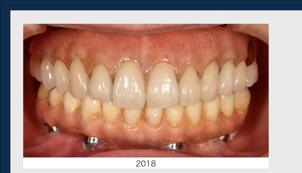 治療から約9年後（2018年）の口腔内写真。上部構造の劣化や汚れの付着が見られる