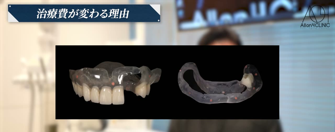 治療計画に用いるラジオグラフィックガイドの写真