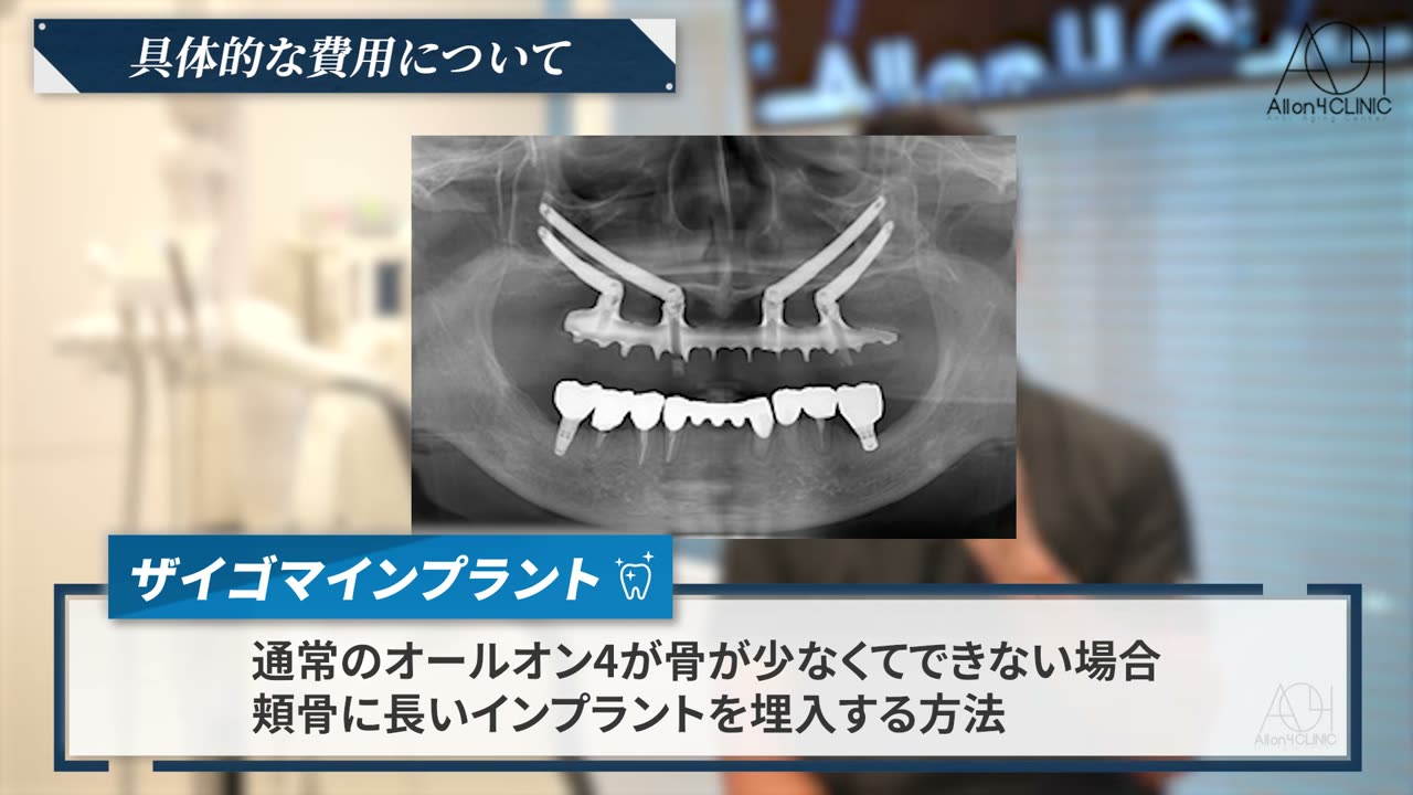 頬骨に長いインプラントを埋入するザイゴマインプラントを示すレントゲン画像と説明スライド