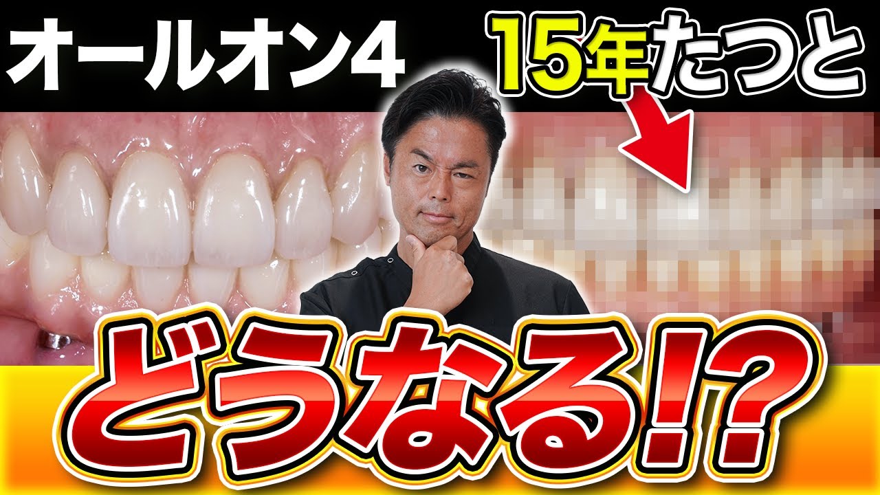 15年たったオールオン4はどうなる？長期症例で見るインプラントと人工歯の変化