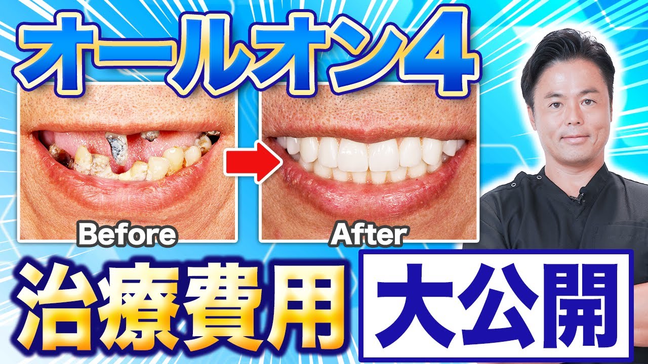 オールオン4の費用の内訳とは？クリニックで費用が異なる理由と支払い方法