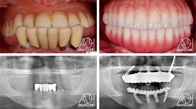 オールオン4症例