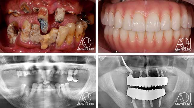 オールオン4症例