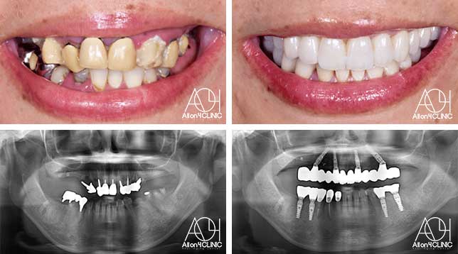 オールオン4症例
