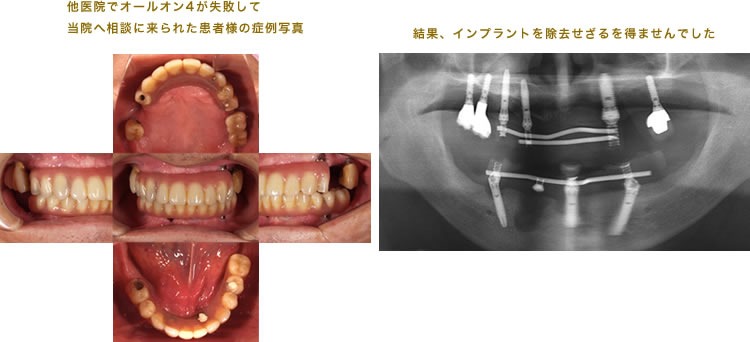 他院でオールオン４が失敗して当院へ相談に来られた方の症例写真。インプラントを除去せざるを得ませんでした。