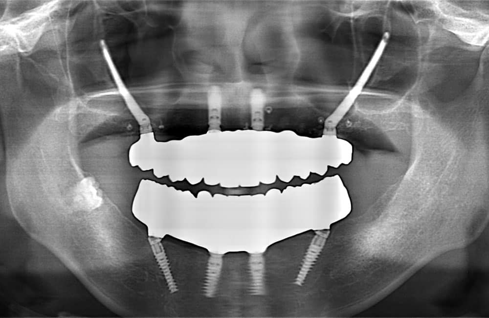 オールオン4ハイブリッドレントゲン画像1