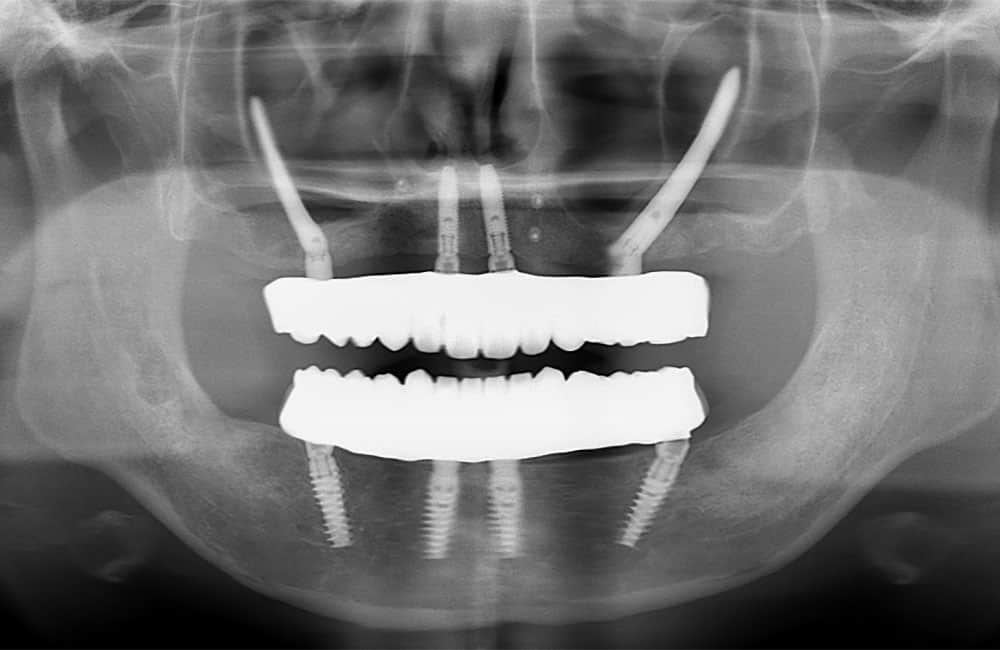 オールオン4ハイブリッドレントゲン画像2
