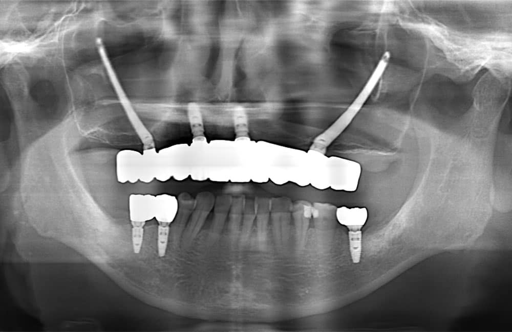 オールオン4ハイブリッドレントゲン画像3