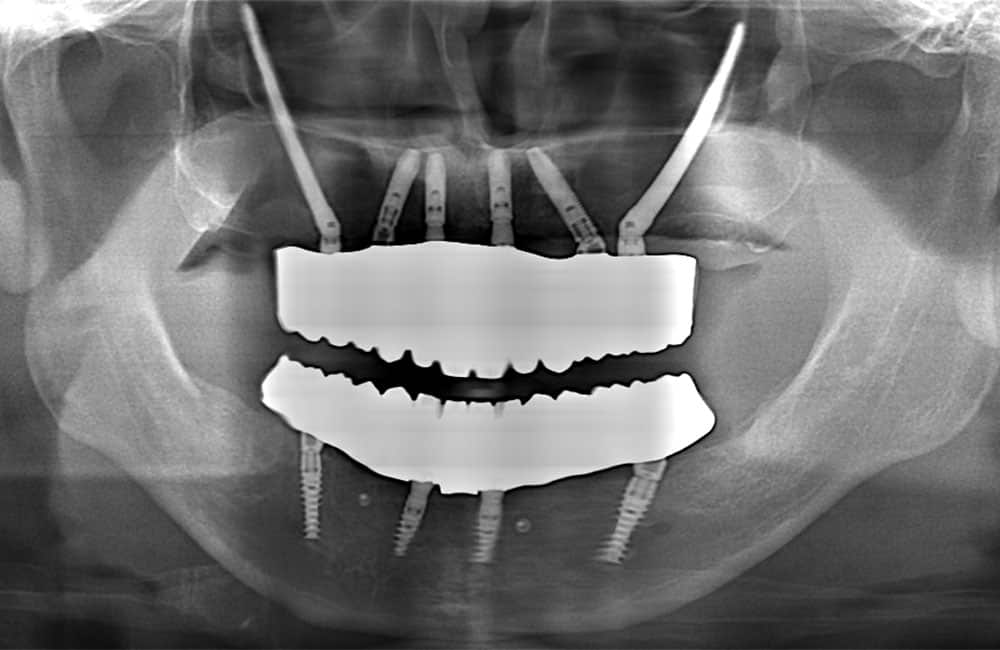 オールオン4ハイブリッドプラス2レントゲン画像1