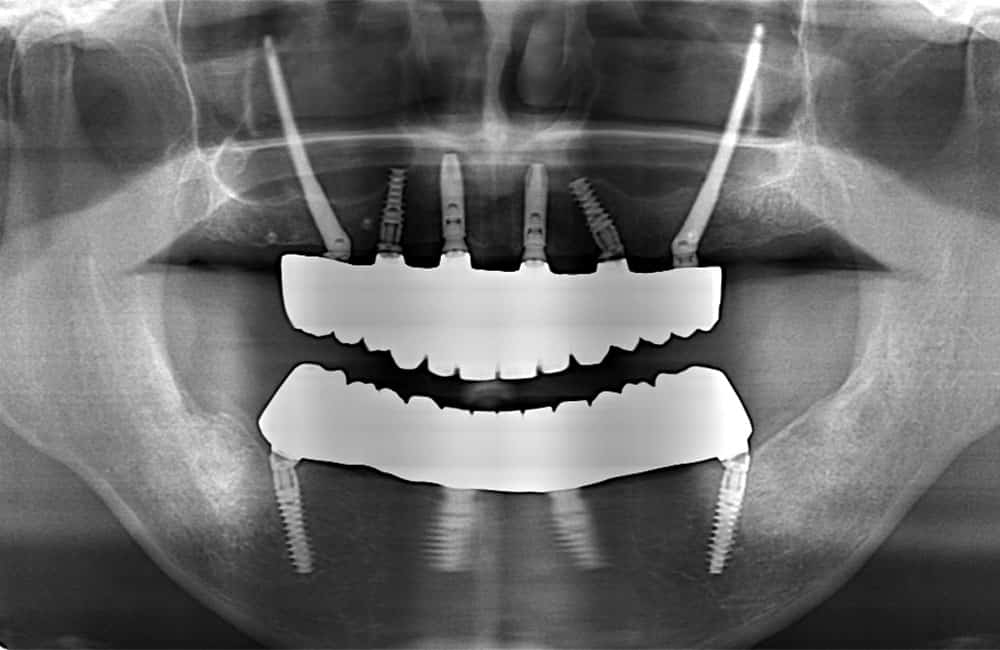 オールオン4ハイブリッドプラス2レントゲン画像2