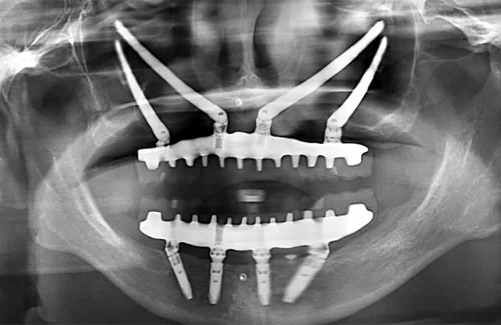 オールオン4ハイブリッドプラス2レントゲン画像1