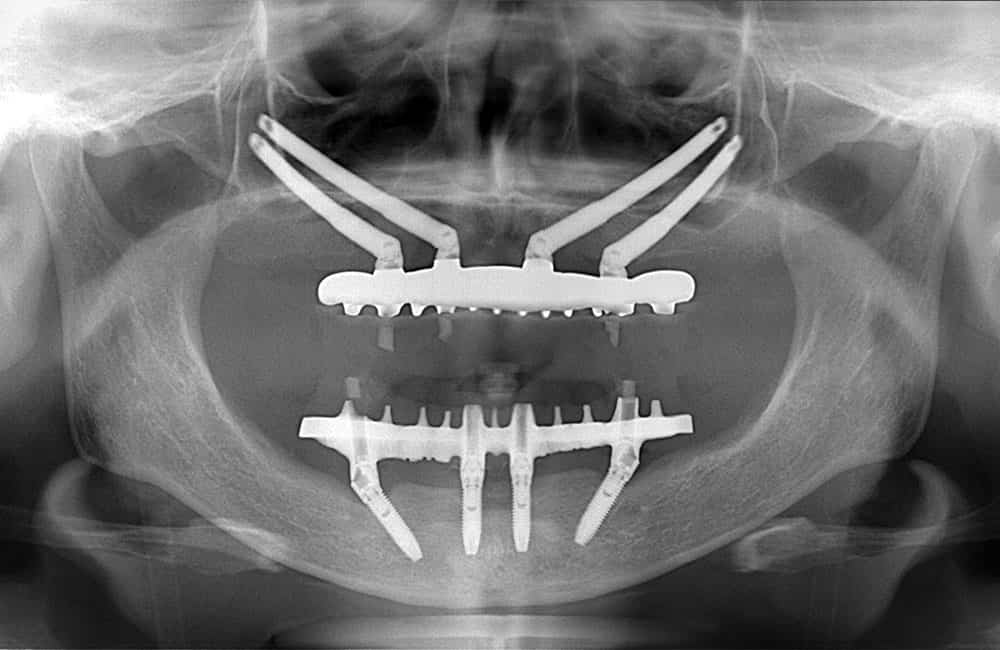 オールオン4ハイブリッドプラス2レントゲン画像2