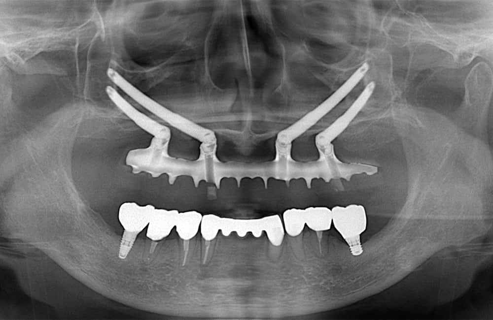 オールオン4ハイブリッドプラス2レントゲン画像3