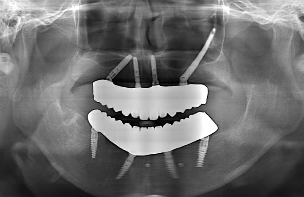 その他のザイゴマインプラントレントゲン画像1