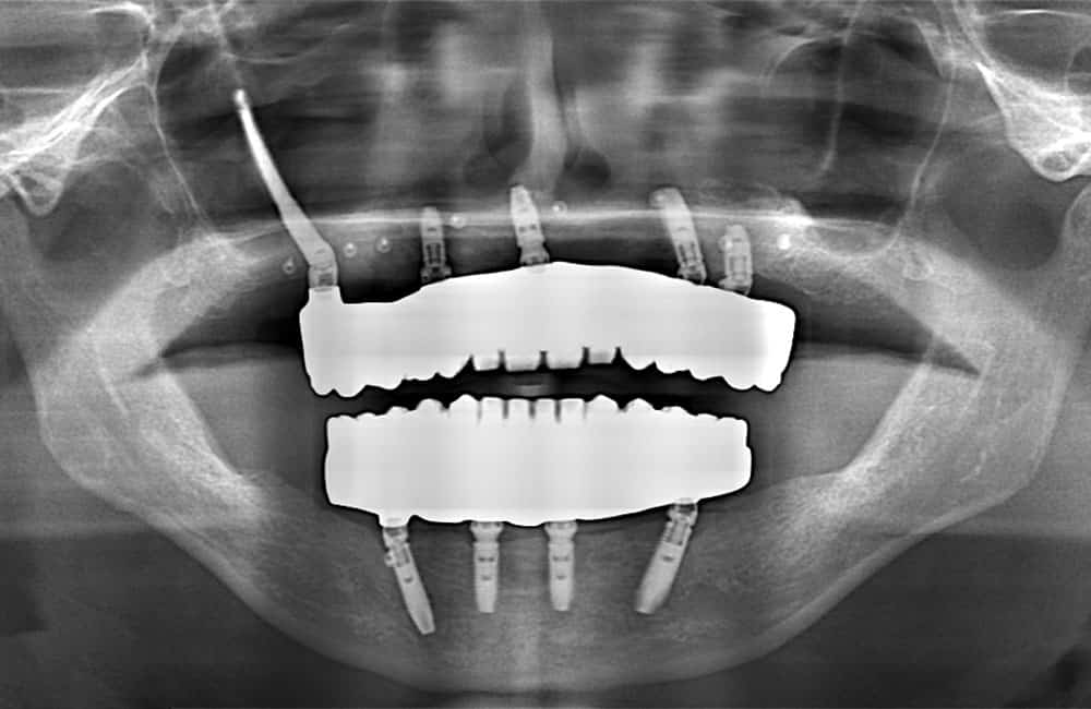 その他のザイゴマインプラントレントゲン画像2