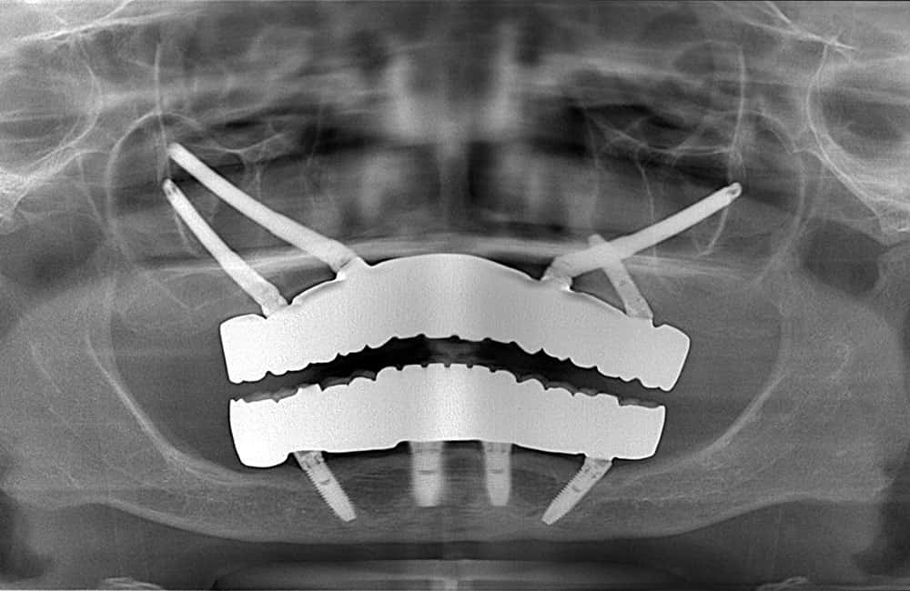 その他のザイゴマインプラントレントゲン画像3