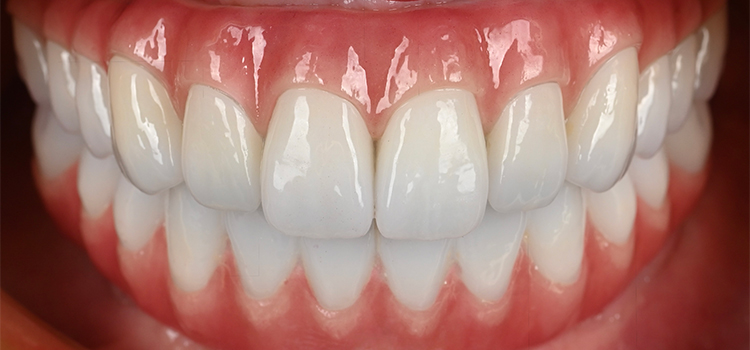 こだわりの補綴（人工歯）