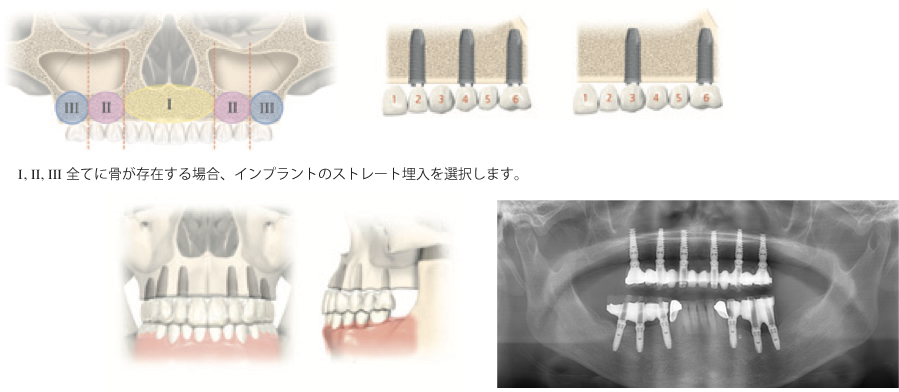 インプラントストレート埋入