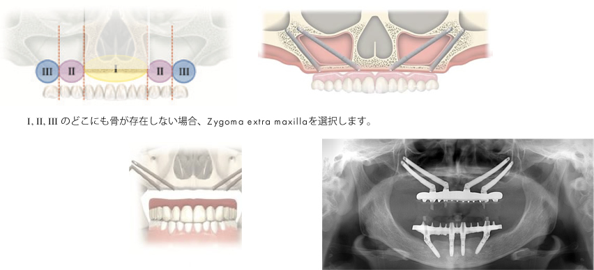 zygoma extra maxilla