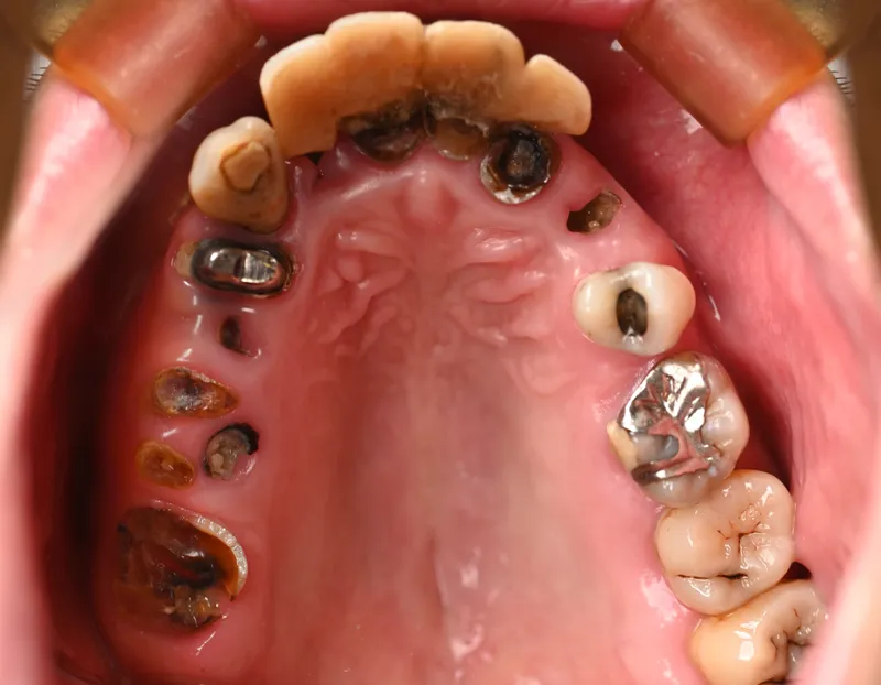 当院でオールオン４を受けたモニター患者様