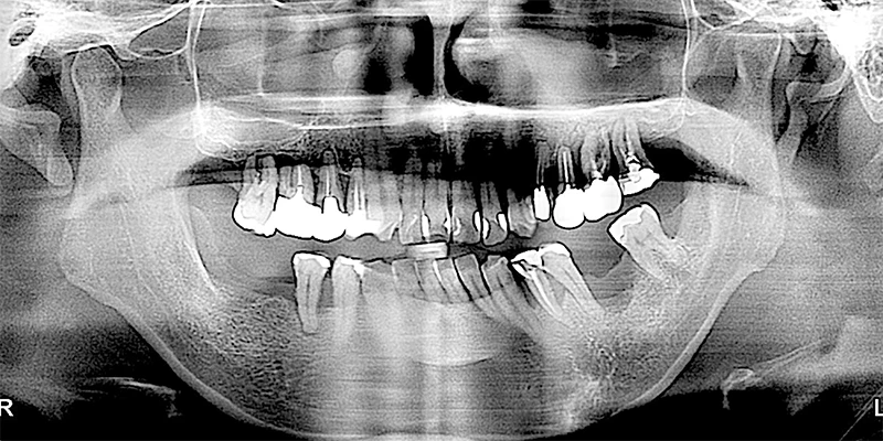 新生活に向け、専門医によるオールオン4治療を希望された症例